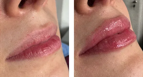 web_servicios_dr_carlos_carvajal_labios.webp
