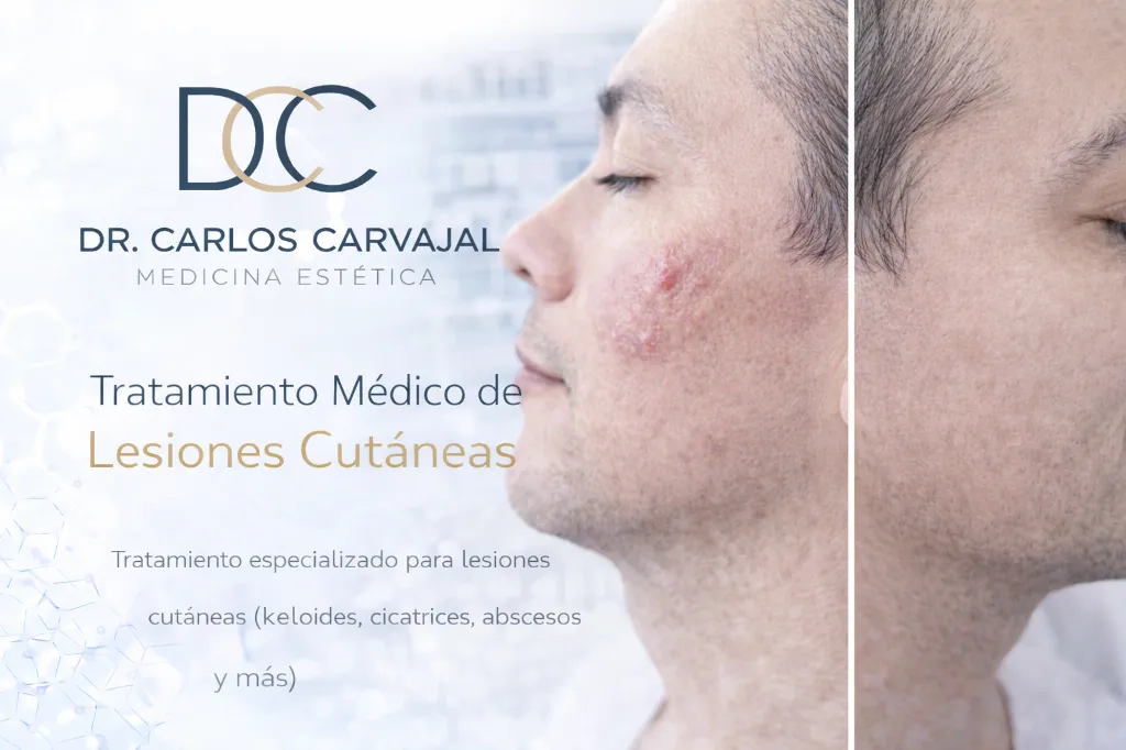 [Cauterización] Cauterización